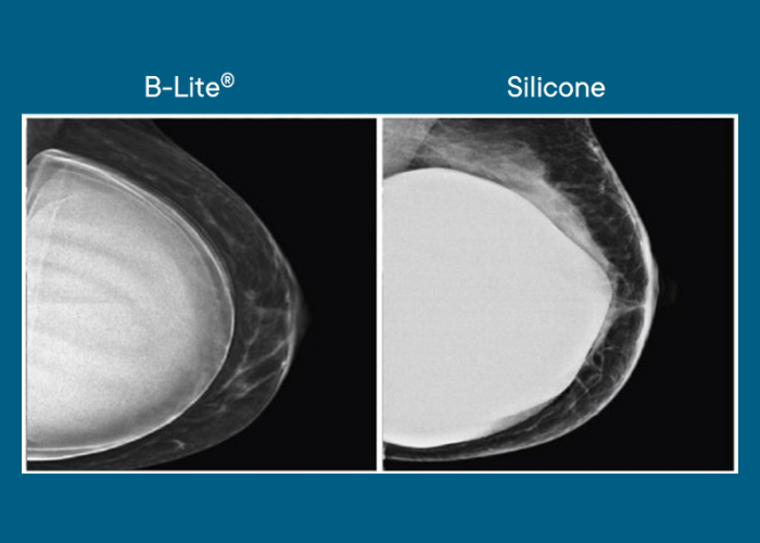 Brustkrebsvorsorge mit B-Lite Implantaten