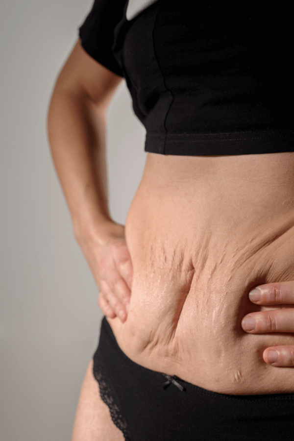 Patientin nach Bauchdeckenstraffung