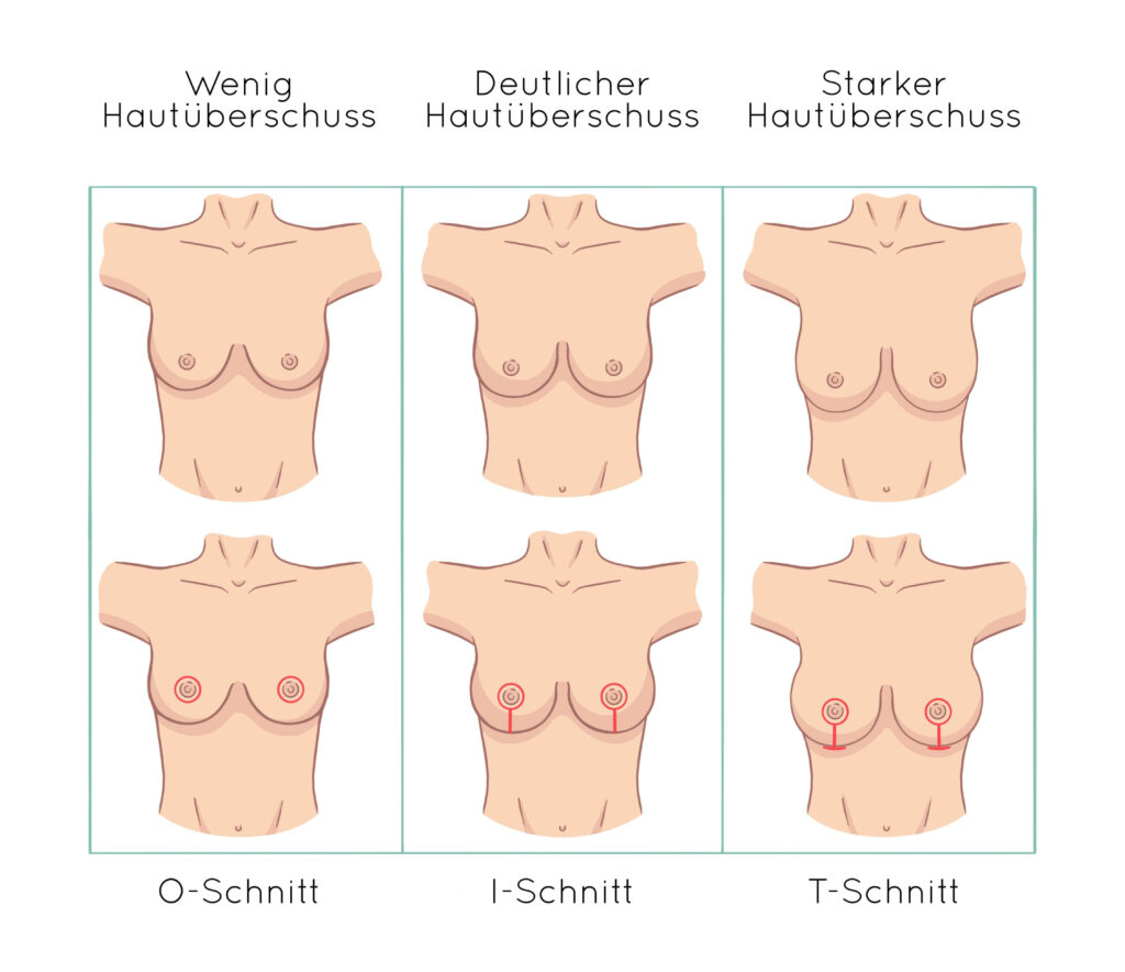 Übersicht der Schnitttechniken bei einer Bruststraffung in Abhängigkeit vom Hautüberschuss