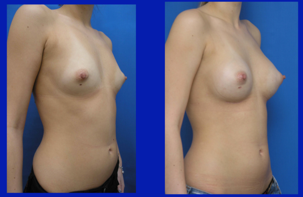 Brustvergrößerung mit Implantat | Dr. von Finckenstein