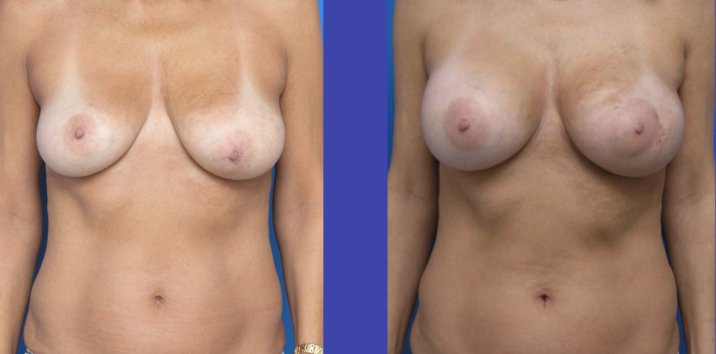 Vorher Nachher Bilder einer Brustvergrößerung mit Asymmetrie-Anpassung