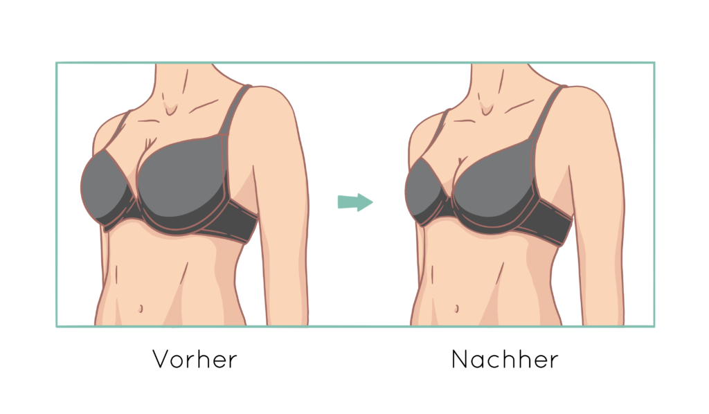Ergebnis einer Brustverkleinerung