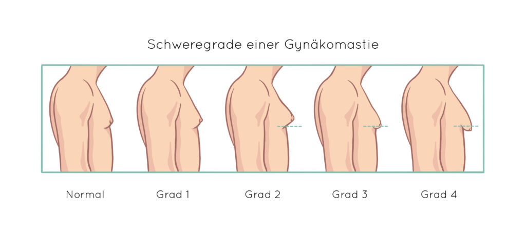 Schweregrade einer Gynäkomastie