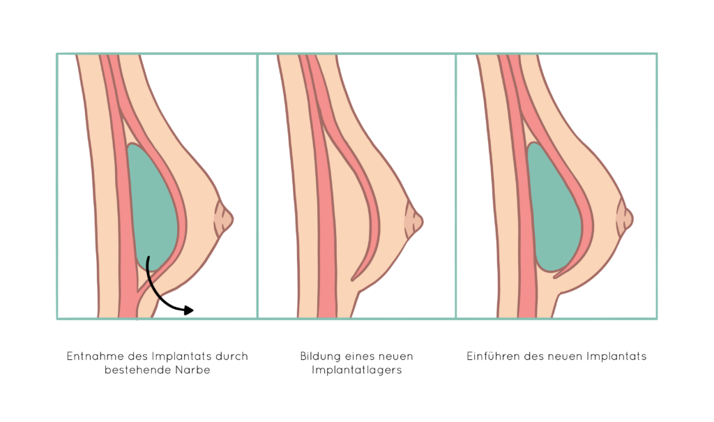 Ablauf eines Implantatwechsels