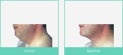 Ergebnis eines Necklifts im Vorher-Nachher Vergleich