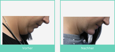 Ergebnis einer Doppelkinn Entfernung (Necklift) im Vorher-Nachher Vergleich